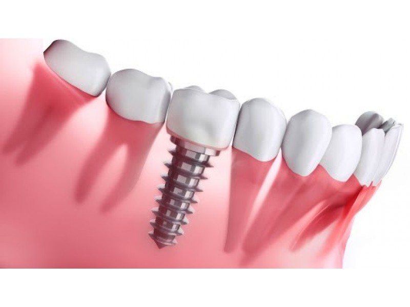 Dantų implantacija ir jos raida