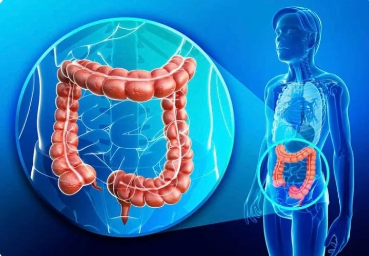 Žarnų vėžys gali nepataisomai pakeisti gyvenimą: gydytojas pataria, kaip palaikyti šio organo sveikatą – nuotrauka 1
